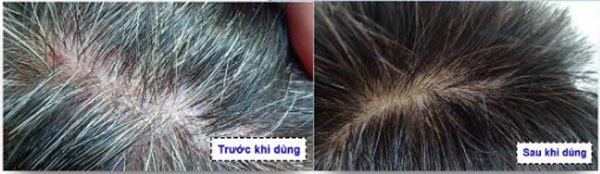 Bệnh vảy nến da đầu của anh Quốc đã cải thiện rõ rệt sau khi dùng Kim Miễn Khang & Explaq